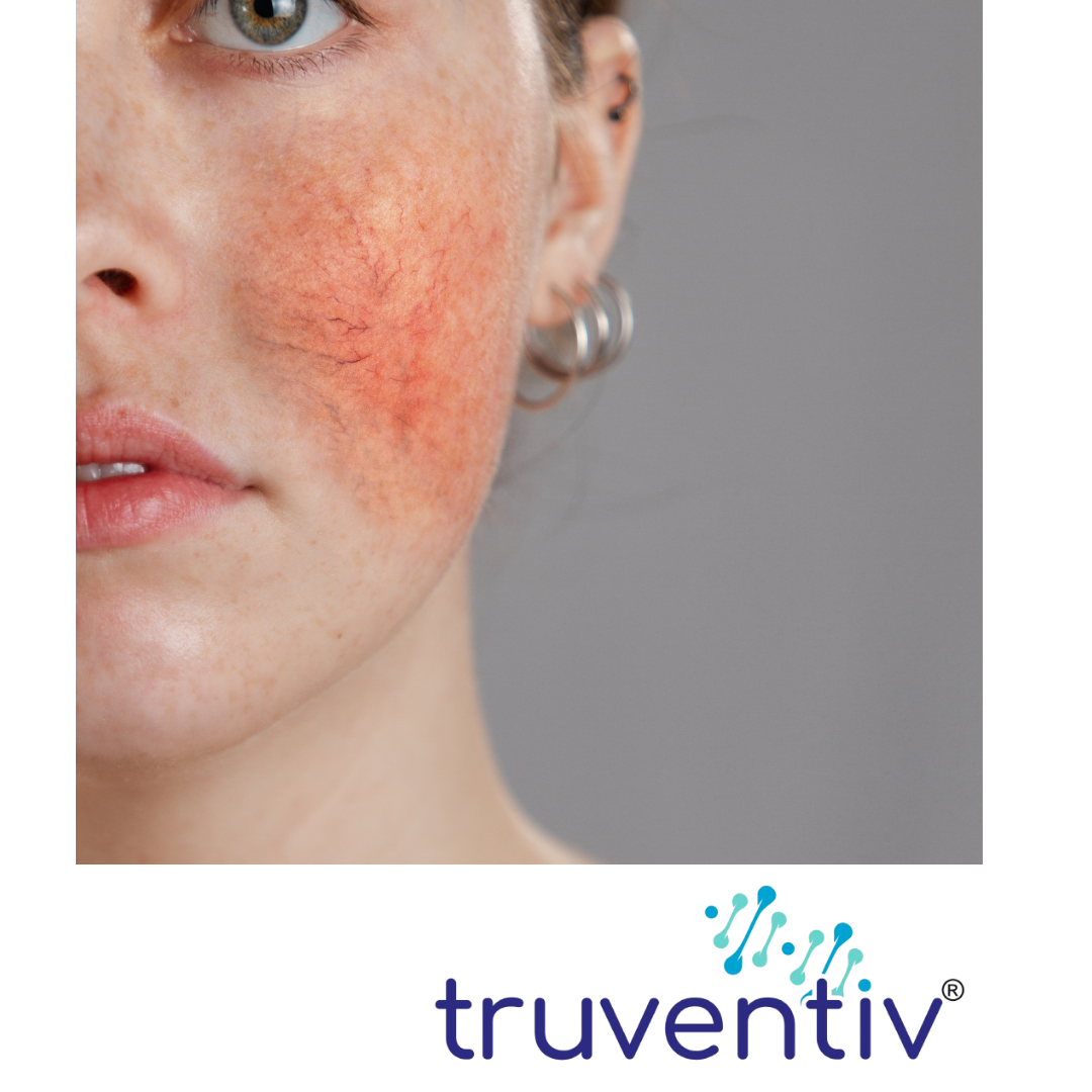 CALMS SKIN CONDITIONS LIKE ECZEMA, ROSACEA & PSORIASIS