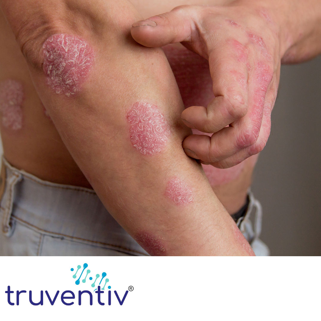 CALMS SKIN CONDITION LIKE ECZEMA, ROSACEA & PSORIASIS